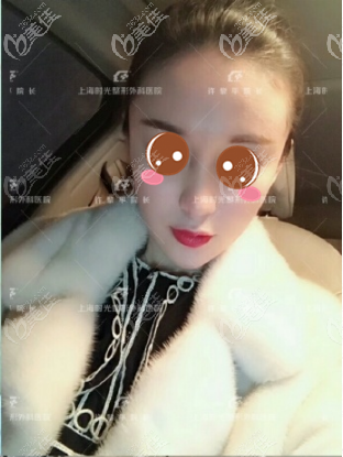 <!--<i data=20240703-sp></i>-->時(shí)光許黎平自體脂肪面部填充案例術(shù)后十五天