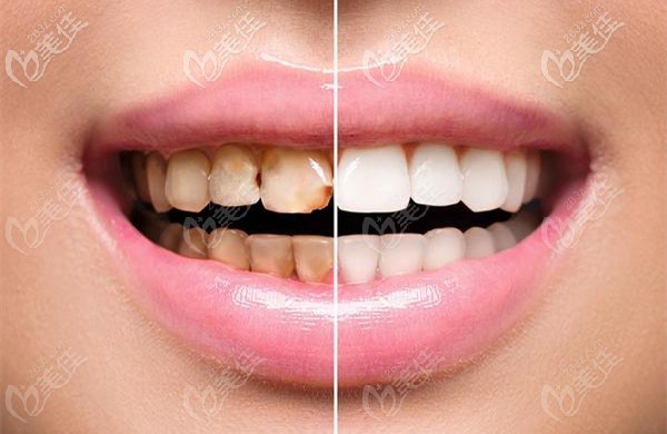 美白牙齒前后的效果對(duì)比圖
