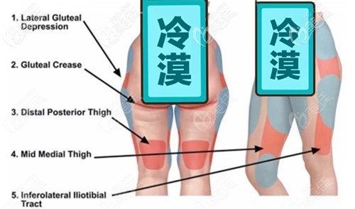 大腿環(huán)吸抽脂部位分布圖