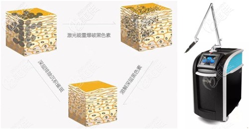 李院長(zhǎng)做皮秒激光祛斑的手術(shù)原理 李院長(zhǎng)做皮秒激光祛斑的手術(shù)原理