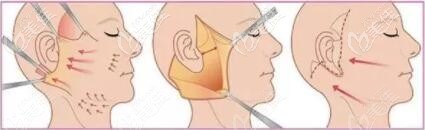 大拉皮手術(shù)過程示意圖