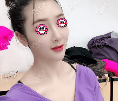 做二代超皮秒祛黃褐斑3次后不但沒有加重,而且基本上也沒有復(fù)發(fā)喲!