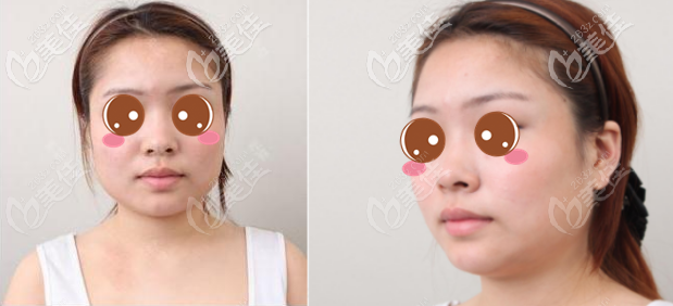 韓國原辰下頜角切除真人案例術(shù)前照 韓國原辰下頜角切除真人案例術(shù)前照