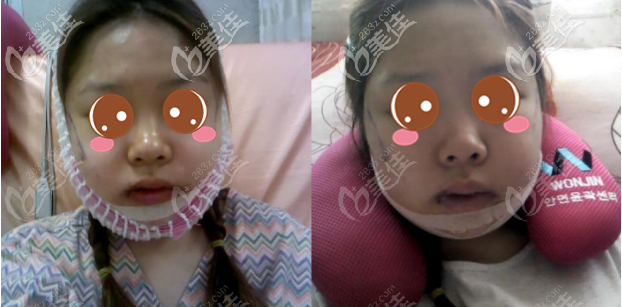 韓國原辰下頜角切除真人案例術(shù)后第三天 韓國原辰下頜角切除真人案例術(shù)后第三天