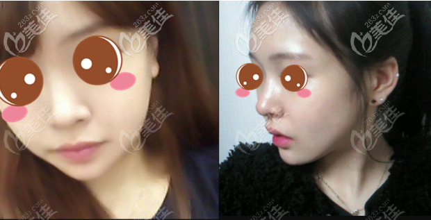 韓國原辰下頜角切除真人案例術(shù)后二十八天 韓國原辰下頜角切除真人案例術(shù)后二十八天