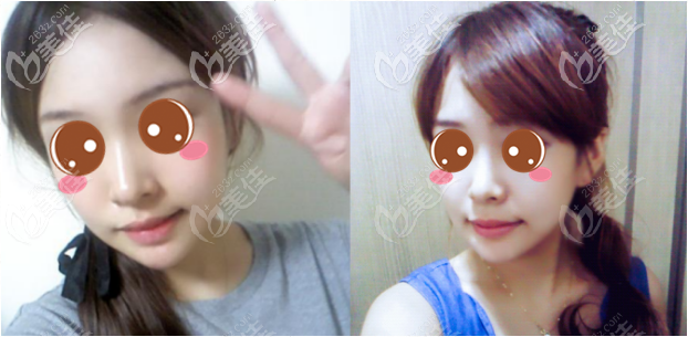 韓國原辰下頜角切除真人案例術(shù)后四十二天 韓國原辰下頜角切除真人案例術(shù)后四十二天