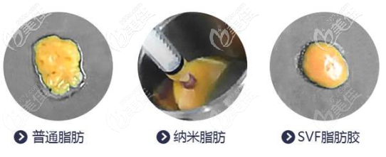 SVF脂肪膠，納米脂肪和普通自體脂肪哪個(gè)豐胸好
