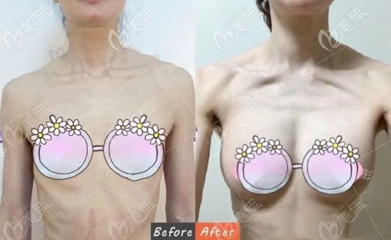 普通自體脂肪300毫升豐胸增大2個(gè)罩杯效果圖