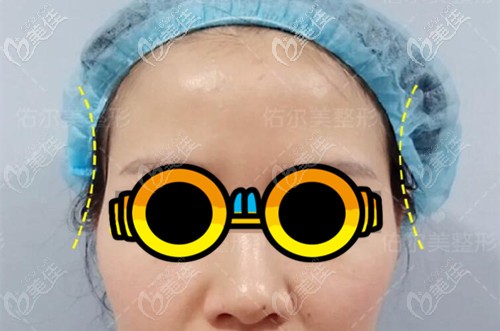 太陽(yáng)穴填充前凹陷明顯 太陽(yáng)穴填充前凹陷明顯