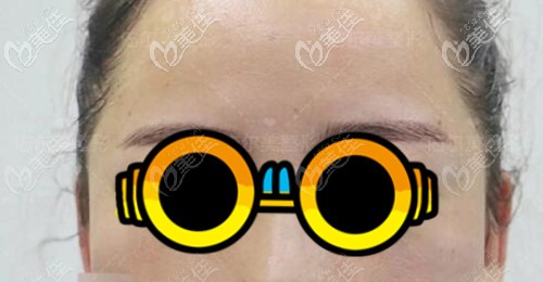 脂肪填充太陽(yáng)穴術(shù)后6個(gè)月效果 脂肪填充太陽(yáng)穴術(shù)后6個(gè)月效果