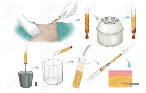 脂肪填充過(guò)程 脂肪填充過(guò)程