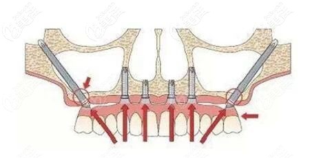 牙槽骨極度缺失患者
