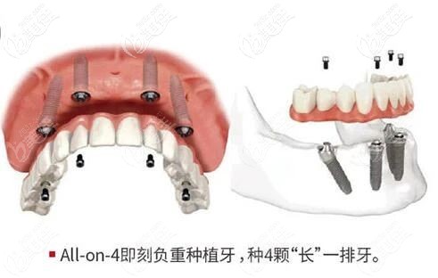 不想有空牙期的患者