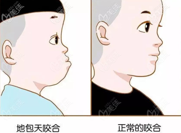 “地包天”面型和正常面型的區(qū)別圖