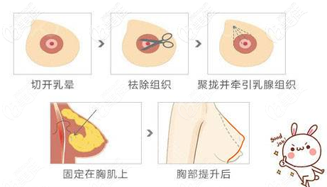 雙環(huán)法乳房提升手術(shù)切口