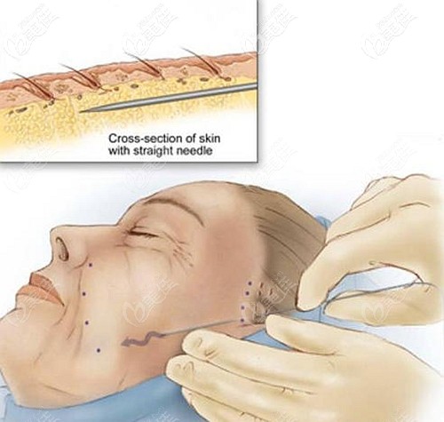 張年翁醫(yī)生做全臉埋線提升的優(yōu)勢 張年翁醫(yī)生做全臉埋線提升的優(yōu)勢