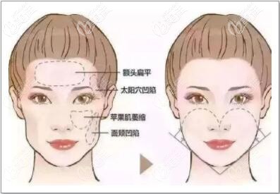 面部凹陷做注射填充好不好