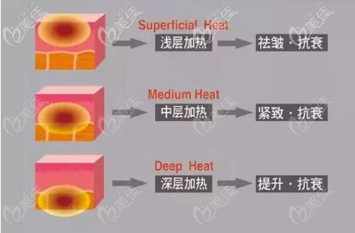 熱拉提單頭和雙頭的治療作用
