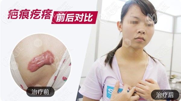 成都美容整形醫(yī)院疤痕科是怎么治療胸前疤痕疙瘩的?這里有祛疤成功案例