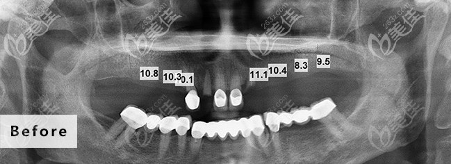 沒種牙時候的樣子 沒種牙時候的樣子