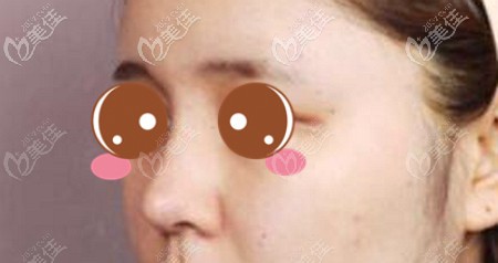 南陽集美用來隆鼻的硅膠假體有柳葉型和I型，我優(yōu)先選擇了前者