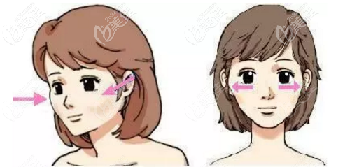 一針降顴骨顴弓