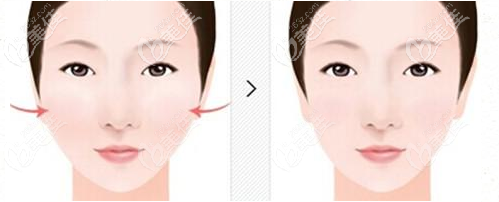 一針降顴骨顴弓會(huì)導(dǎo)致臉下垂嗎？