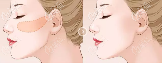 一針降顴骨顴弓能夠降低多少毫米