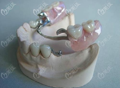 掛鉤假牙的外觀 掛鉤假牙的外觀