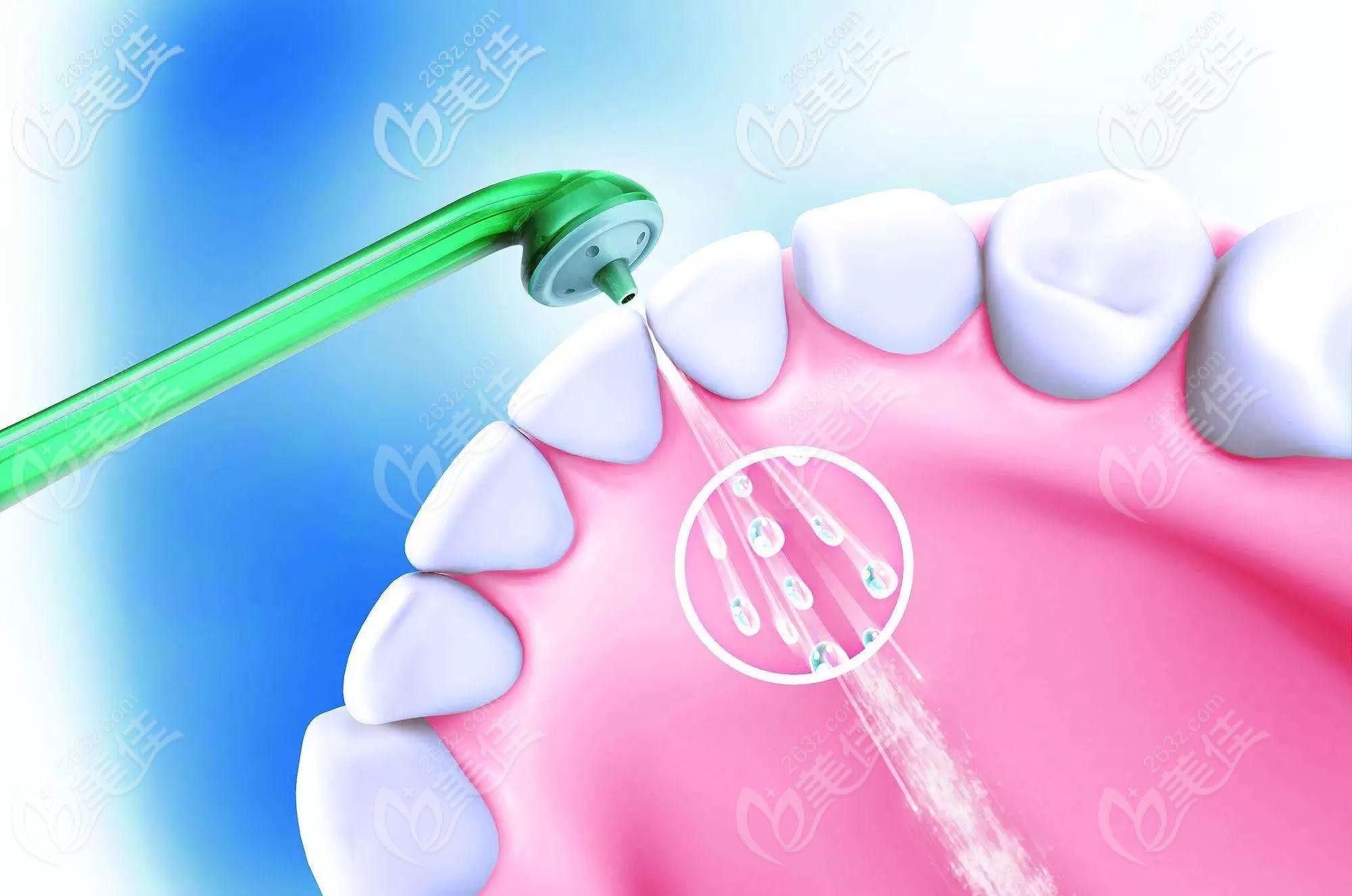 超聲波潔牙示意圖 超聲波潔牙示意圖