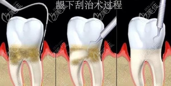 牙周潔治術(shù)示意圖 牙周潔治術(shù)示意圖