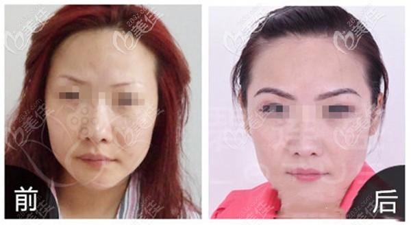 碧蓮盛眉毛種植案例圖