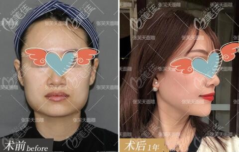 北京圣嘉新張笑天做的下頜角長(zhǎng)曲線截骨實(shí)例前后對(duì)比圖
