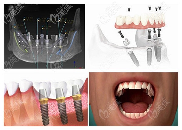 鑫西華口腔種牙優(yōu)勢點