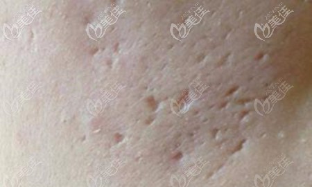 冰錐型痘坑圖片 冰錐型痘坑圖片
