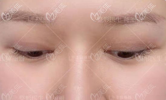 我做全切雙眼皮修復(fù)沒(méi)有損傷眼皮 我做全切雙眼皮修復(fù)沒(méi)有損傷眼皮