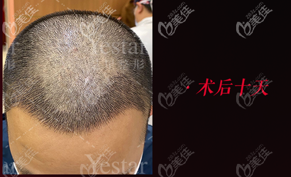 關(guān)于深圳藝星男士m型發(fā)際線植發(fā)案例及手術(shù)費(fèi)多少錢等問(wèn)題,今日開(kāi)說(shuō)...