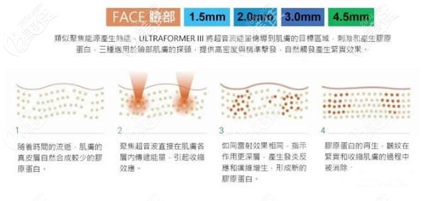 第三代7D聚拉提面部提升工作原理