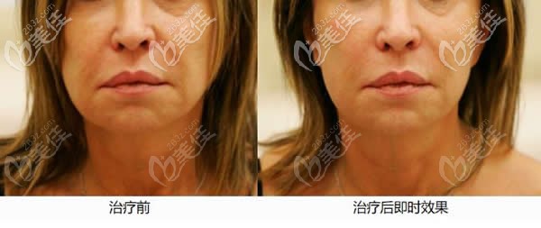 7D聚拉提術(shù)前和術(shù)后即刻效果對比圖