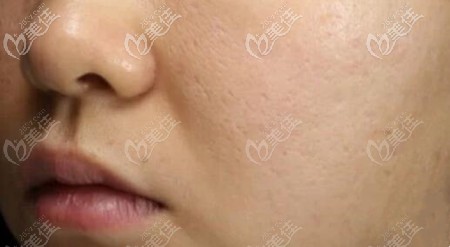 做了3次點陣激光后的效果 做了3次點陣激光后的效果