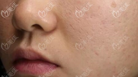 治療前的痘坑明顯 治療前的痘坑明顯