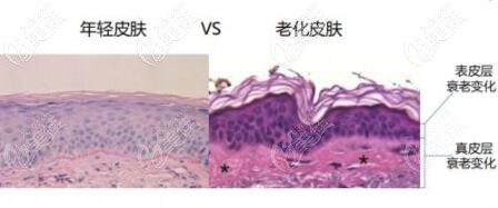 年輕皮膚與老化皮膚的對(duì)比示意圖 年輕皮膚與老化皮膚的對(duì)比示意圖