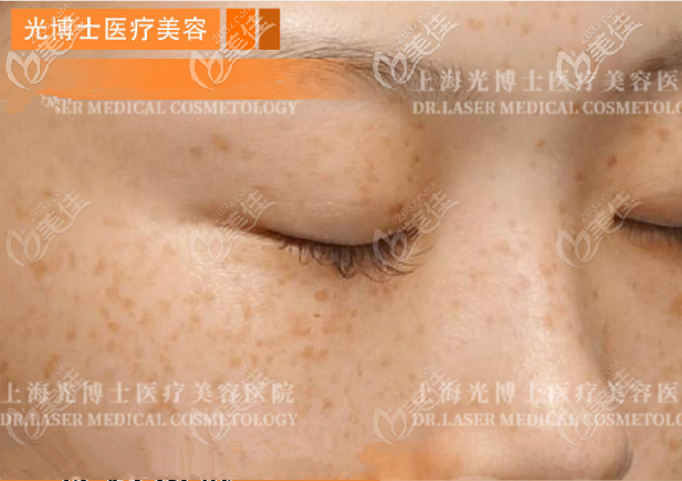 <!--<i data=20240703-sp></i>-->光博士皮秒祛斑術(shù)前照 <!--<i data=20240703-sp></i>-->光博士皮秒祛斑術(shù)前照