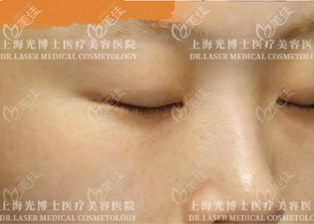 貪便宜做蜂巢皮秒3次后長(zhǎng)了很多斑，得到教訓(xùn)后去光博士做皮秒嫩膚斑沒(méi)了