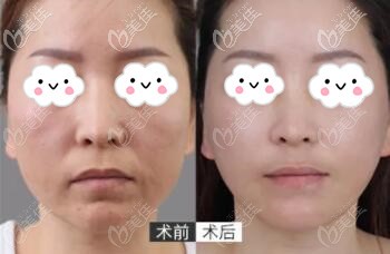 娃娃針平復(fù)口角紋真人前后對(duì)比照 娃娃針平復(fù)口角紋真人前后對(duì)比照