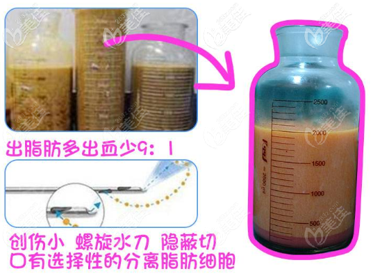 水 動(dòng)力吸脂出來(lái)的脂肪效果圖