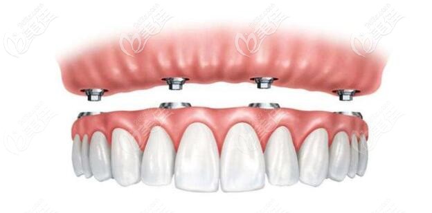 半口半固定種植