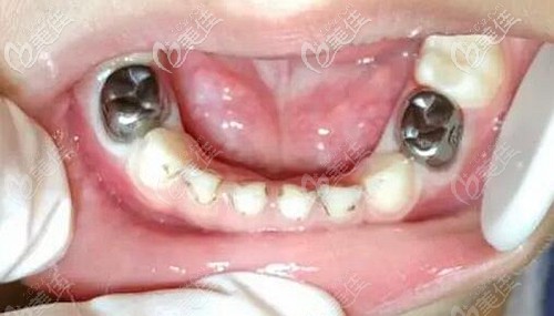 孩子乳牙做牙冠的利弊