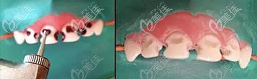 乳牙齲齒做牙冠的好處