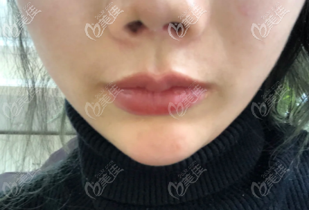 取出鼻假體15天鼻子攣縮成朝天鼻